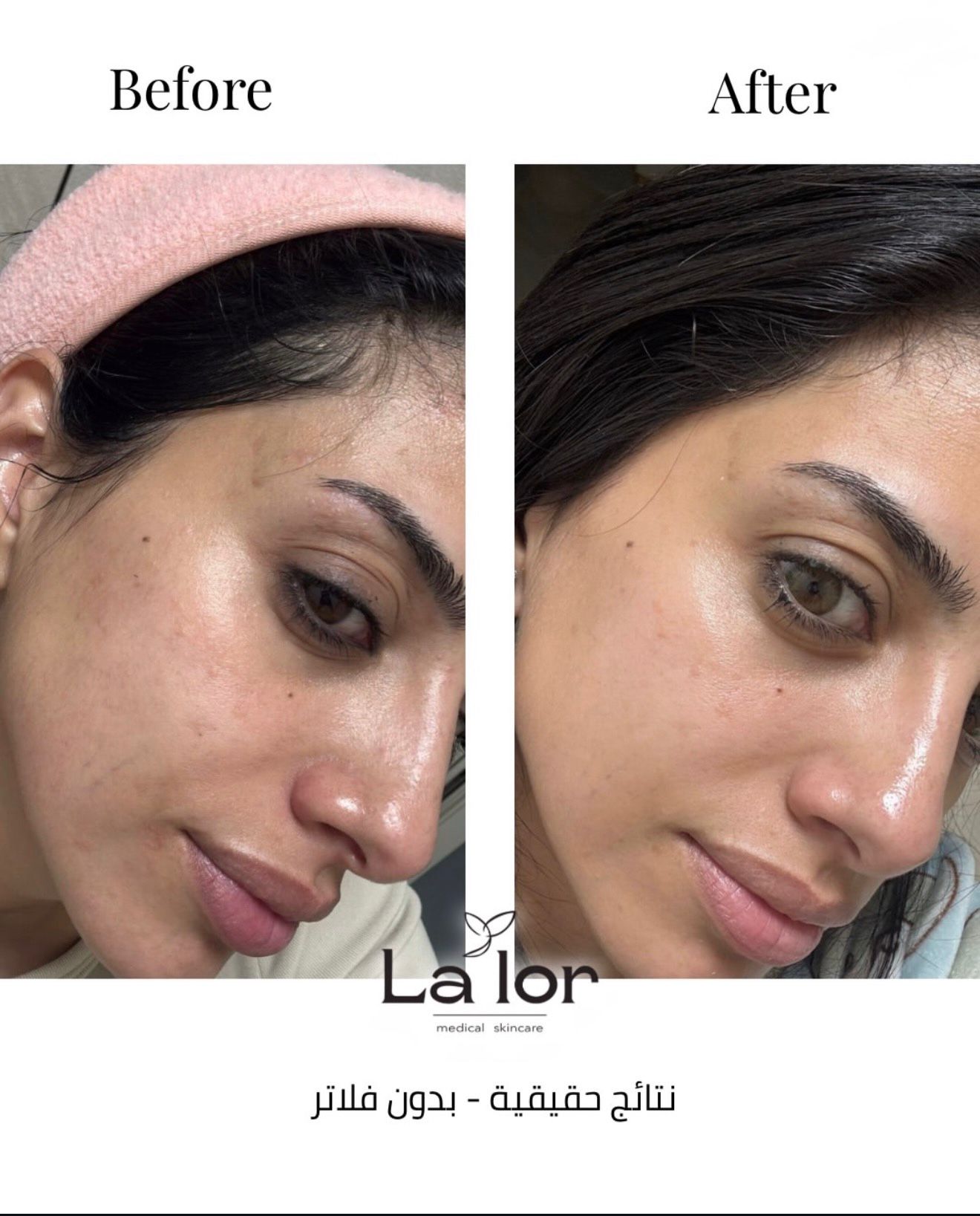 Before and after — Skin Glow treatment
