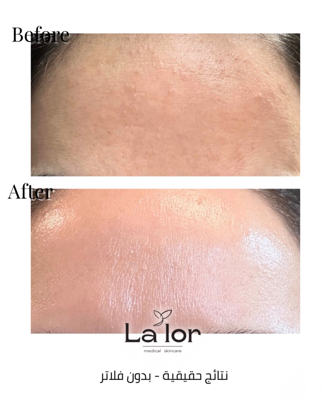 Before and after — Skin Texture treatment