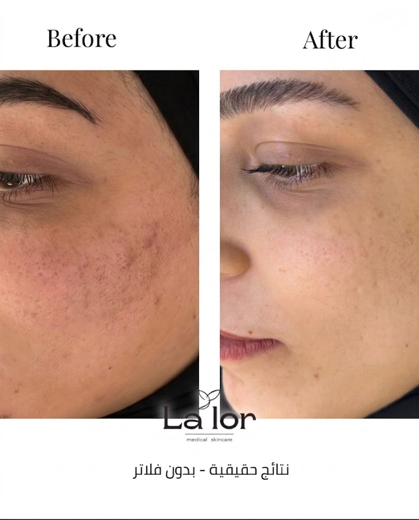 Before and after — Post Acne treatment